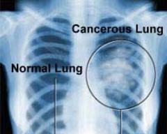 CT detects twice as many lung cancers as X-ray at initial screening exam
